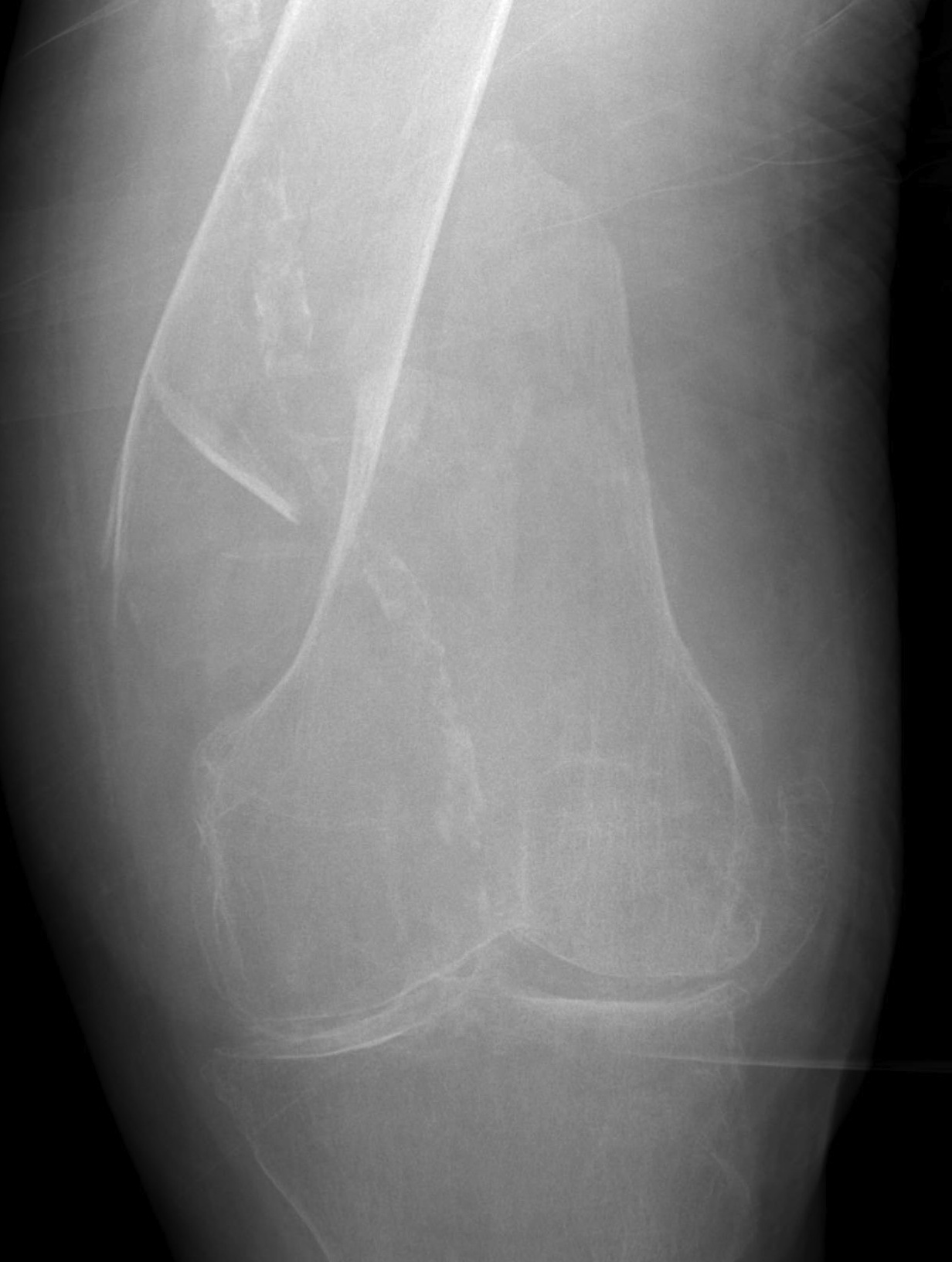 Distal femoral fracture